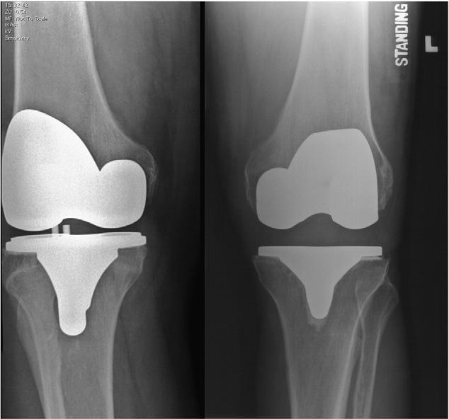 Exclusion criteria were as follows: follow-up less than 2 years; a history of patellectomy, high tibial osteotomy, unicompartmental prosthesis, bicompartmental prosthesis, fixed or rotating hinge