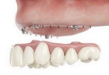 Grind away the palatal plate of the denture and reduce the buccal base plate (2a).