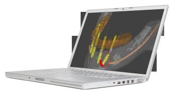Simplant computer guided implant treatment Simplant computer guided implant treatment Simplant software and surgical guides can be used for the