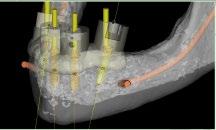 For the SmartFix concept, normally plan for a distally tilted placement of the posterior implant on each side.