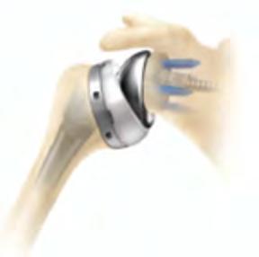 Reverse Total Shoulder Arthroplasty FDA approved in US 2003 Originally used for rotator cuff tear arthropathy Indications have expanded rapidly