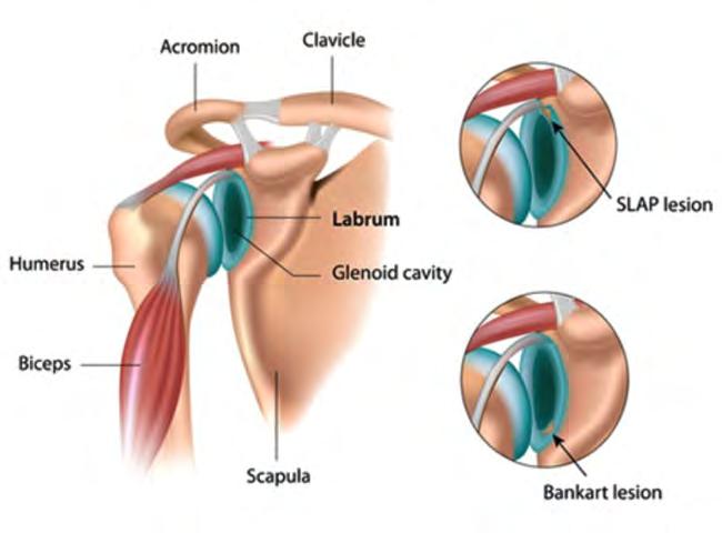 Glenohumeral Anatomy Labrum: Circumferential cartilage ring Deepens socket