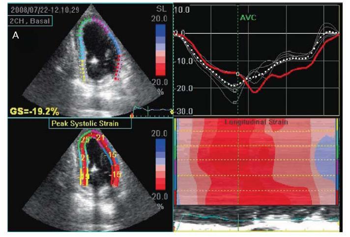 Myocardial Ischemia The direct observation of a developing systolic dysfunction
