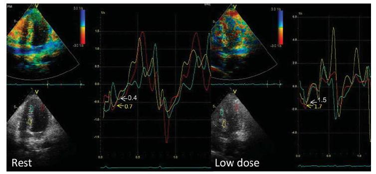 Fibrosis and Viability Recommendation: The place of deformation analysis is the recognition and evaluation of fibrosis and myocardial viability is a matter of ongoing investigation.