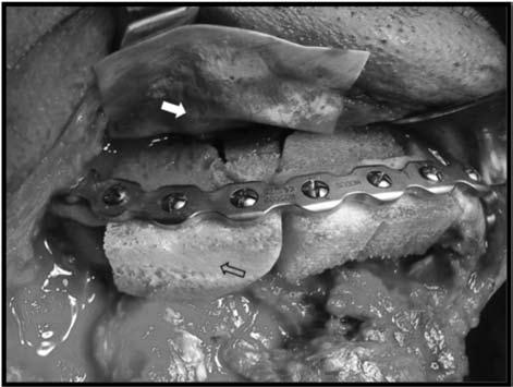 material- (Maxresorb, Botiss Medical AG, Berlin, Germany) bone grafts may be used in other regions. (Figure 3) Figure 1. Ameloblastoma.