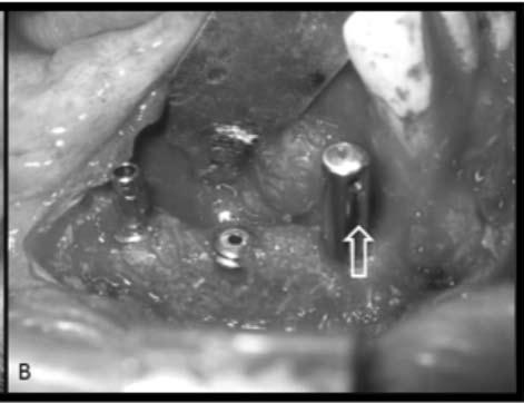 Figure 8. Bone biopsy & placement of osteo-integrated implants. (A) Biopsy of the neomandible for histologic evaluation at 9 months post-reconstruction in conjunction to the sites of dental implants.