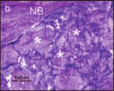 (c) Note the remodeling and the osteon formation (arrows) within a bone substitute particle (BS) Inverted colors (bar= 100 µm).