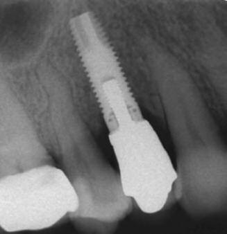 Later on, the implant was restored with a gold ceramic crown (Figures 5 and 6).