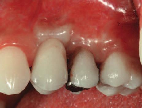 Figure 12: Clinical view of the zirconia and porcelain crown 1 year after the bone grafting.