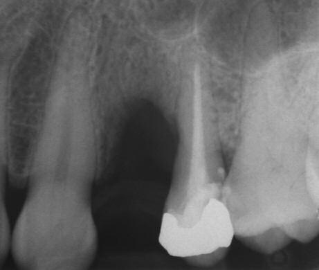 The comparison of the ISQ values at the moment of the implant insertion and at the moment of the abutment positioning, after 10 months, revealed in both cases a significant increment (first case: