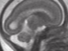 Normal preterm MRI Germinal matrix-low on T2,high on T1 WM-Low TI,high T2 20-30