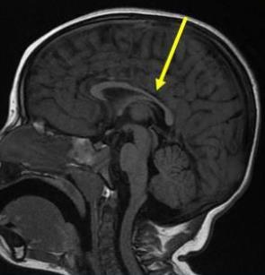 CHRONIC WM INJURY Thinning of the corpus callosum, particularly in the posterior