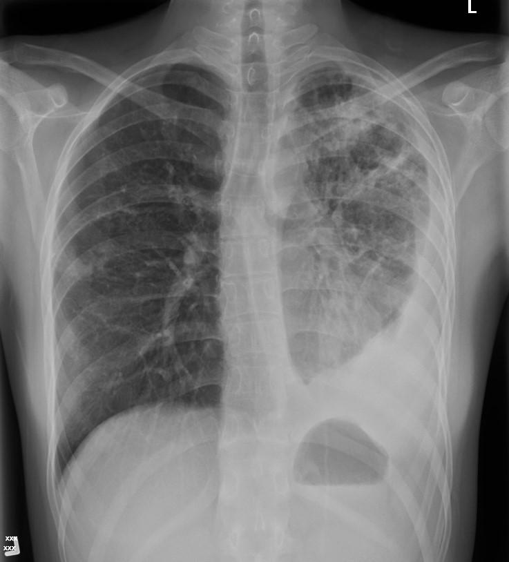 CXR in the diagnosis of active TB Typical findings 90% have infiltrate in apicoposterior segment of UL or superior segments of LL Loss