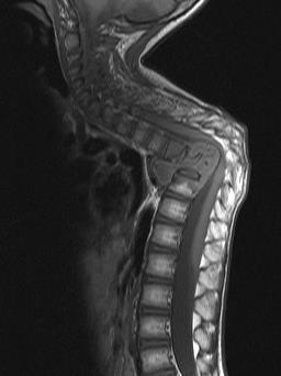 Case 1 Young boy with severe kyphosis after failing 2