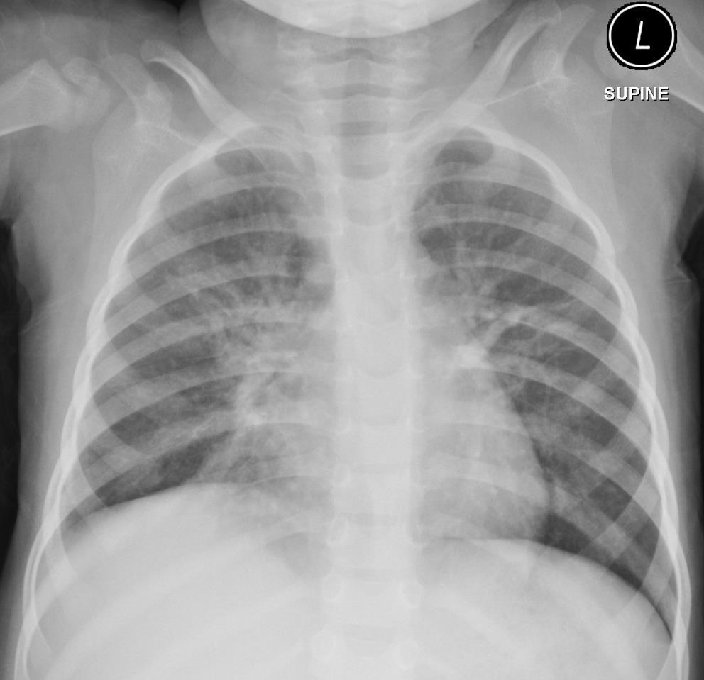 Case 2 18-month-old girl presented with cough