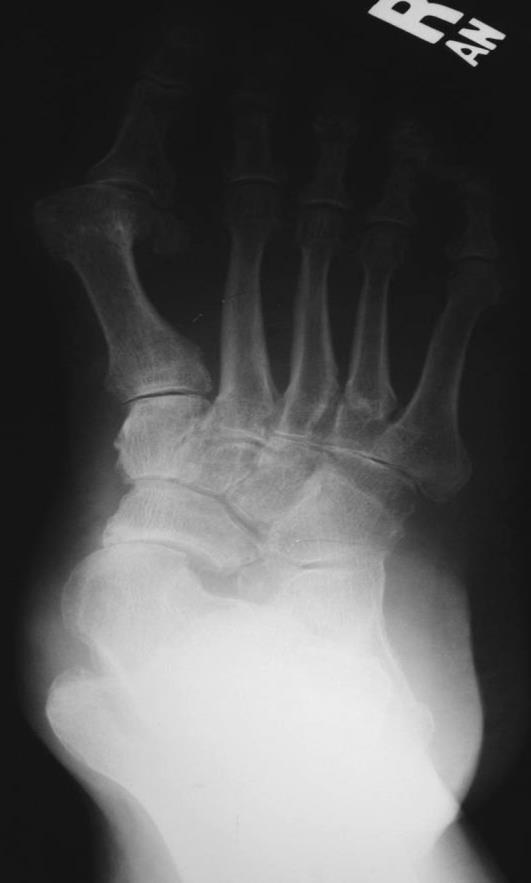 Hindfoot alignment Views Pics Ankle