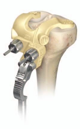 With the knee flexed at 90 degrees, place the tibial resection guide and uprod assembly onto the proximal anterior medial aspect of the tibia and both plateaux.