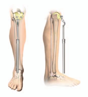 The planned Varus/Valgus (V/V) alignment can be confirmed by verifying the alignment of the rod to the patient s tibial crest (Figure 5).