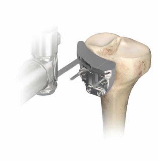 PROXIMAL TIBIAL RESECTION After drilling the two anterior pins, the TRUMATCH drill guides are removed by twisting in a counter-clockwise direction, while leaving the two anterior pins in place