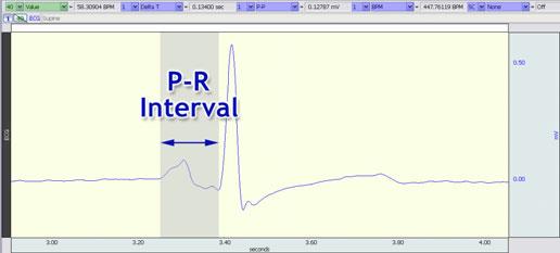 Use the I-Beam cursor to select segments and measure the durations and wave amplitudes required for the Data Report. Use P-P measurement to obtain amplitudes.