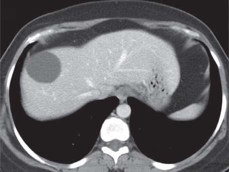 THAI J 136 Imaging Approach to Cystic Liver Lesions GASTROENTEROL 2013 X-Ray Corner Imaging Approach to Cystic Liver Lesions Pantongrag-Brown L Cystic liver lesions are common findings in daily