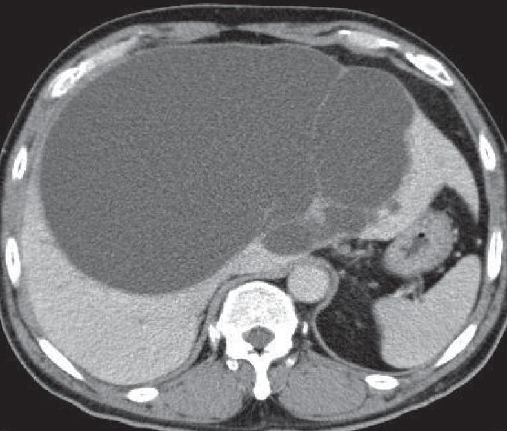 However, in certain endemic areas, amebic, and hydatid cystic liver abscesses need to be considered. Fungal liver abscess tends to occur in immunocompromised host.