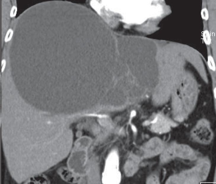 Coalescence of small abscesses may be found, particularly in pyogenic liver abscess. Biliary cystic tumor (Figure 3) Biliary cystic tumor is often found in middle-aged female.