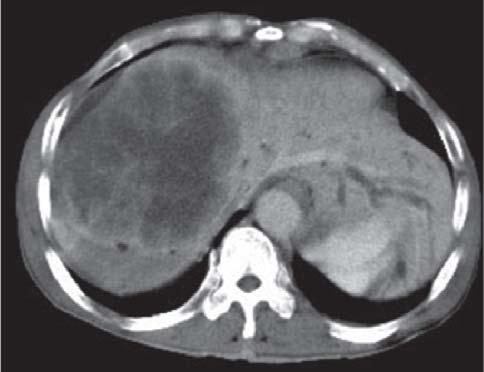 At CT/MRI, it shows multiloculated appearance with highly vascular papillary projections (5). The cystic mass of IPMT-B may show similar CT/MRI appearance to biliary cystic tumor.