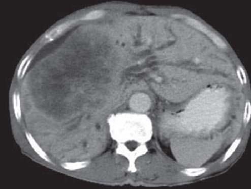 Other necrotic tumors (Figure 5) Primary malignant liver tumor, such as HCC or cholangiocarcinoma, may show extensive necrosis with cystic degeneration.