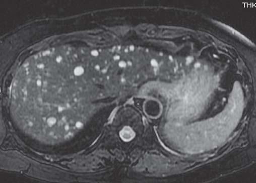 THAI J 140 Imaging Approach to Cystic Liver Lesions GASTROENTEROL 2013 Figure 7.