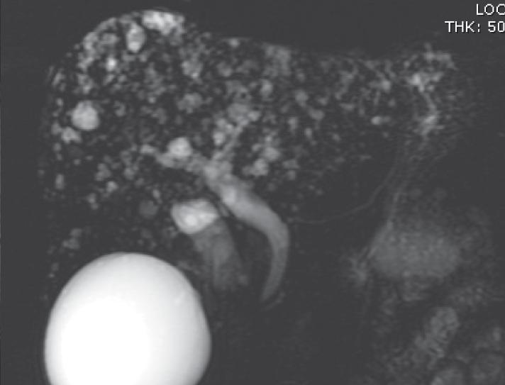 T2W MRI and MRCP show innumerable small cysts scattering throughout the liver.