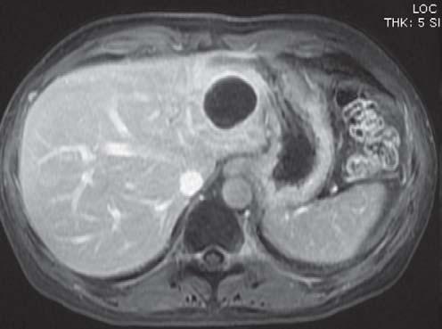 Cystic metastases from primary CA nasopharynx. MRI shows two cystic metastases.
