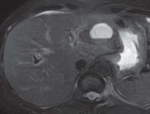 A cyst at right hepatic lobe shows irregular rim enhancement. cal practice. 2.