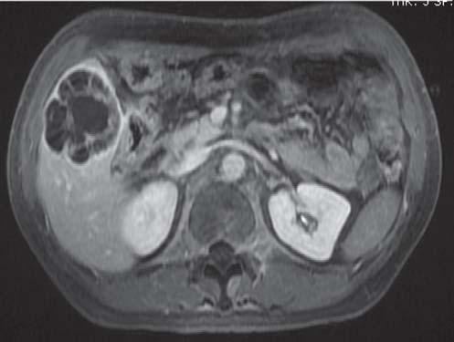 In this approach, lesions are divided into solitary cystic lesions, and multiple