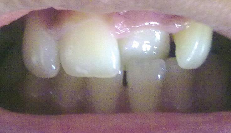 2 ISRN Dentistry permanent tooth germ; supernumerary anterior teeth; an over-retained necrotic or pulpless deciduous tooth or root; odontomas; crowding in the incisor region; inadequate arch length;