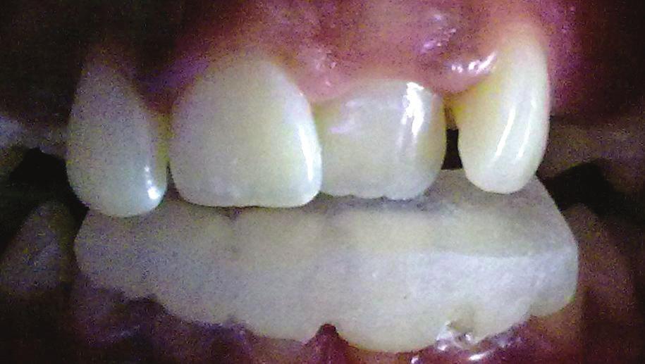 Anterior crossbite may lead to abnormal enamel abrasion of the lower incisors, dental compensation of mandibular incisors leading to thinning of labial alveolar plate, and/or gingival recession [4, 7
