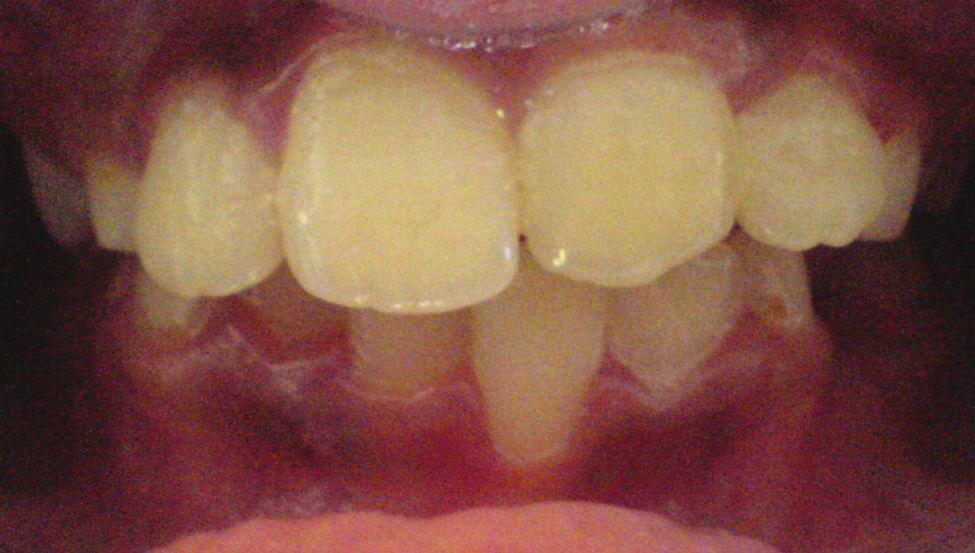 It has to be used only if there is enough space in dental arch for labial movement of the upper incisors.