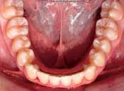 From a dental standpoint, adequate alignment was achieved, the curve of Spee was
