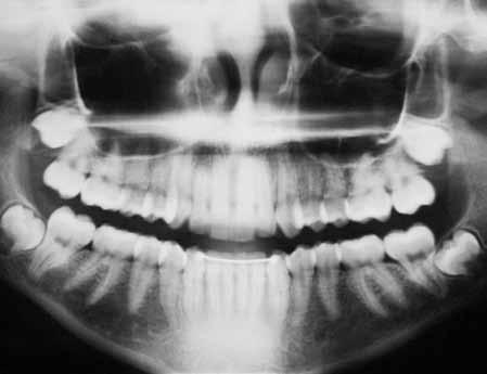 overbite became appropriate and disocclusion guides