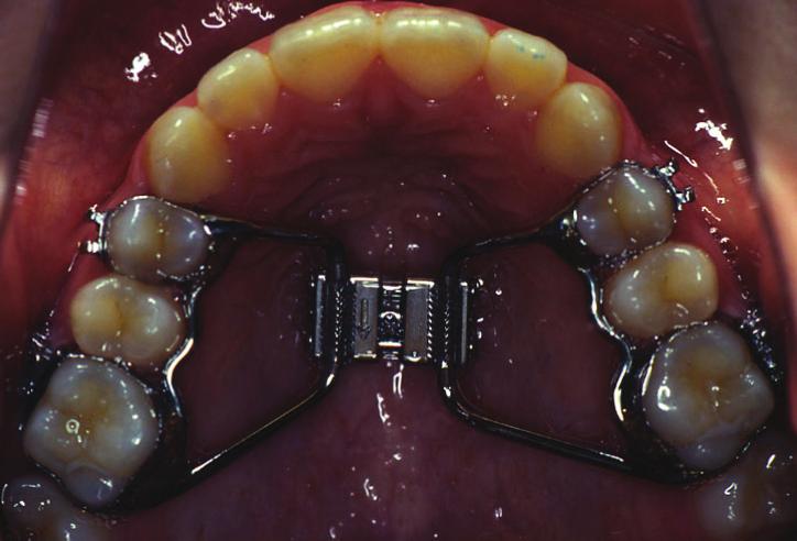 Introduction The routine chief complaints of the patients who seek orthodontic treatment, mostly are spacing or crowding in the dental arches.