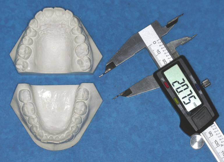 Figure 2 Model measurement at transverse direction randomly selected dental casts. The difference between the measurements did not exceed 0.05 mm, which was considered insignificant.