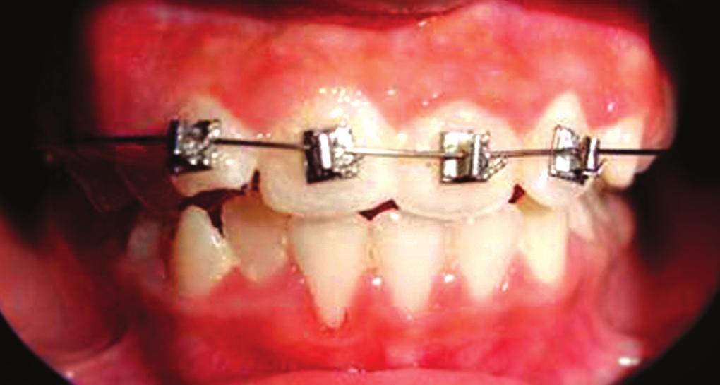 Rapid correction of the incisor relationship occurred and the patient was debonded after two weeks of bonding (Figs 3 to 5) and temporary composite build ups were removed.