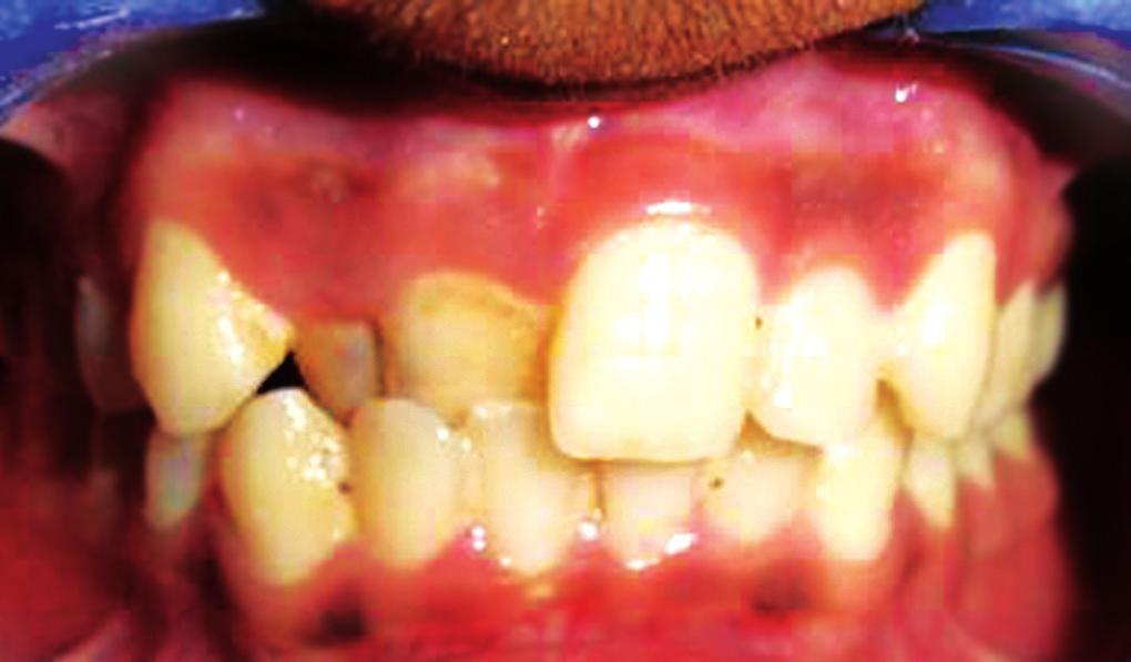 IJCPD Fig. 6: Preoperative showing 11, 12 in cross bite Fig. 9: Correction of cross bite Fig.