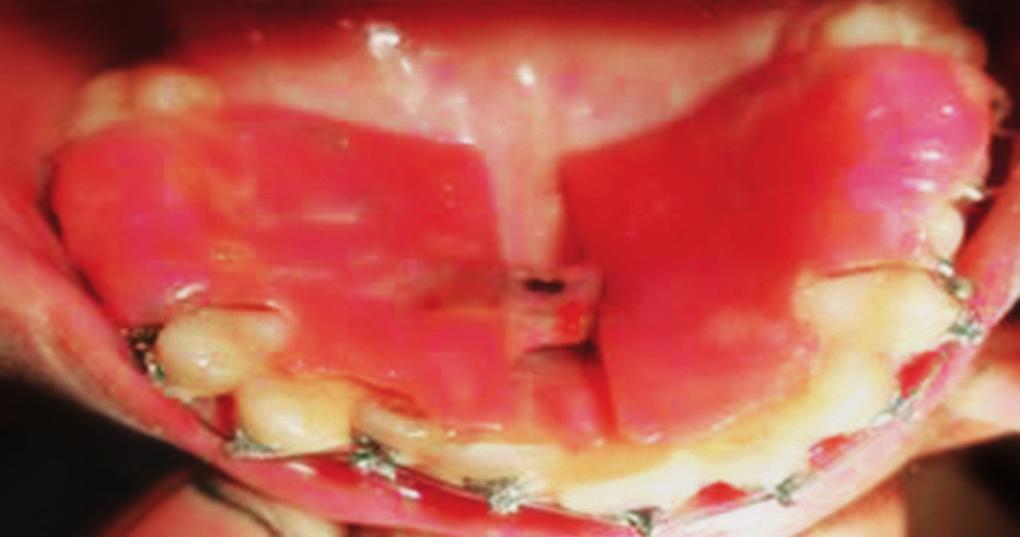 Debonding was done three weeks later, when the anteriorposterior arch relationship with respect to 11and 12 were corrected