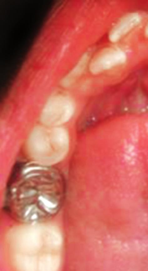 Anirudh Agarwal, Rinku Mathur Fig. 15: Postoperative showing corrected 46 Fig. 12: Stainless steel crown with welded buccal tube Fig.13: Lingual button on palatal of 16 Fig.