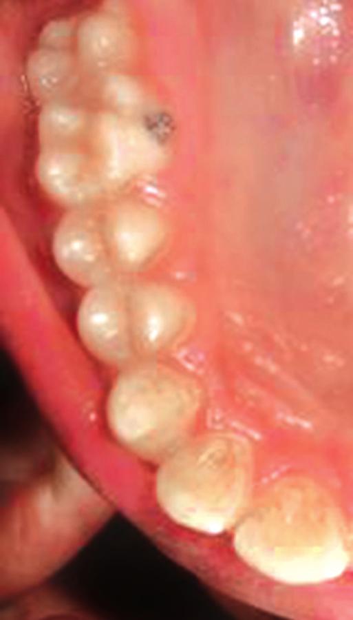 DISCUSSION Cross bites if left untreated can lead to serious oral health problems like a traumatic occlusion can occur, resulting in attrition of teeth, mobility and apical migration of labial