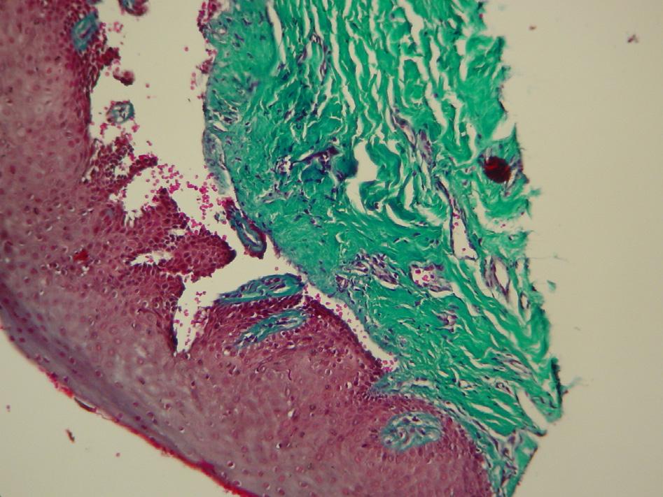 796 The connective tissue subjacent the epithelium was thick, composed of large bundles of collagen with fusiform cells and rare blood vessels (Figure 7). Figure 7 Case no.