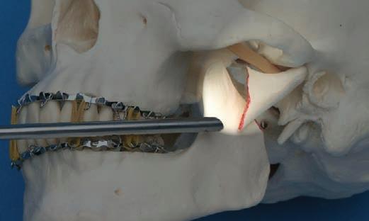 Intraoral Fracture Exposure and Creation of Optical Cavity 3 Insert endoscope Retract the soft tissue