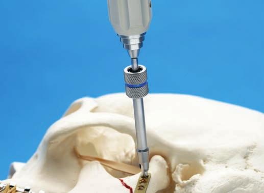 coupling [311.013]. Insert the Manipulation Screw B 1.9 mm through the cannula into the most superior plate hole and thread into the bone.