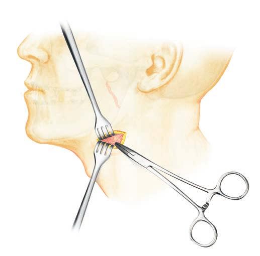Submandibular EXPOSURE AND CREATION OF THE OPTICAL CAVITY 1 Make a 1.5 cm submandibular incision Make a 1.5 cm submandibular incision, 1.5 cm to 2.